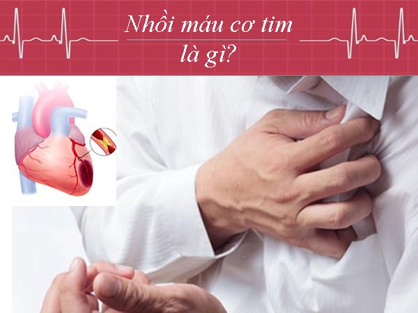 Nhồi máu cơ tim là gì – Nguyên nhân, Dấu hiệu, Cách phòng chống