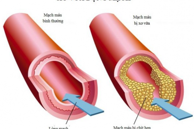 Xơ vữa động mạch và các yếu tố nguy cơ