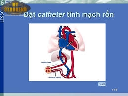 Catheter tĩnh mạch rốn