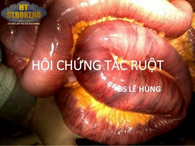 Hội chứng tắc ruột