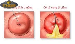 Nhiễm trùng tử cung