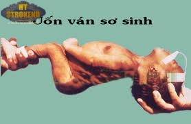 Uốn ván sơ sinh